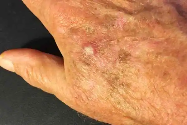 Cryopen For Actinic Keratoses 1 Image of Actinic keratoses Herne on a person hand
